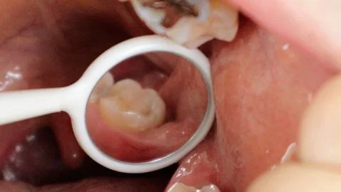 A wisdom tooth that has started to come in a little. Stock Photos