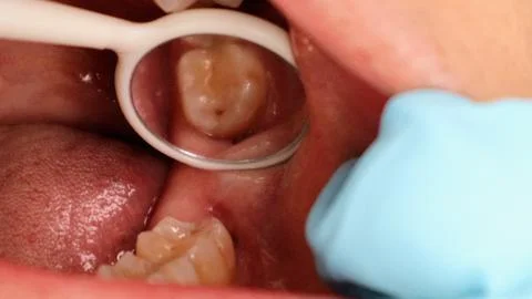 A wisdom tooth that has started to come in a little. Stock Photos