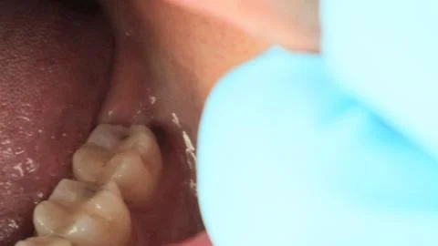 A wisdom tooth that has started to come in a little. Stock Photos