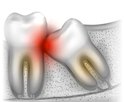 Wisdom tooth Illustrazione stock