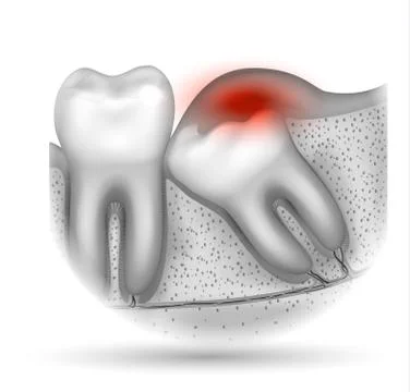 Wisdom tooth Illustrazione stock
