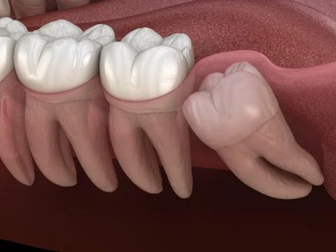 Wisdom tooth with impaction at molar tooth. Medically accurate tooth 3D illus Stock Illustration