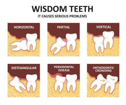 Wisdom tooth. Possible problems because of the third molar Stock Illustration