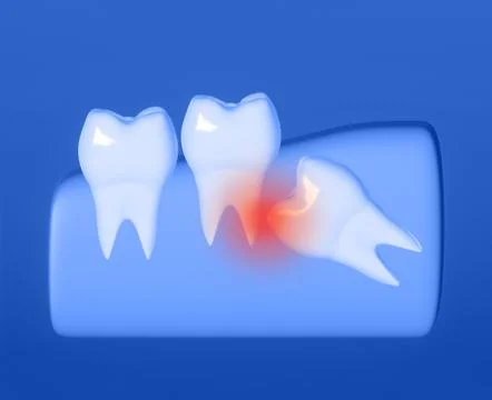 Wisdom tooth problem Stockillustratie