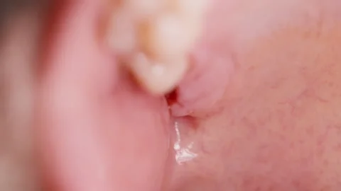 Wisdom Tooth Socket One Day Post Surgery Stock Footage 333493597