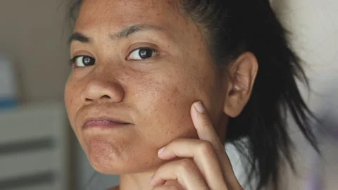 Woman Checking Acne with Concern Close Up 库存影片 332813271