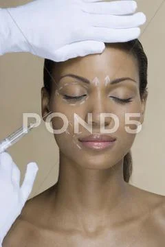 A woman with cosmetic surgery pen marks on her face Stock Photos