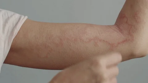 Woman with dermatitis using treatment solution Stock-Footage 119258392