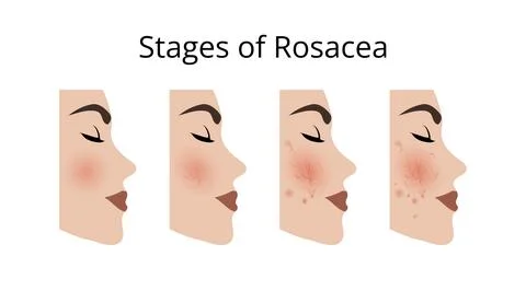 Woman face showing rosacea evolution from stage 1 to 4 Stock Illustration