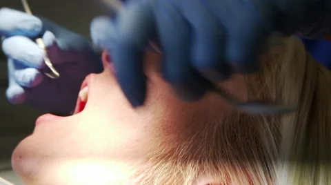 Woman Getting Teeth Cleaned Closeup Side Angle Video stock 43308876