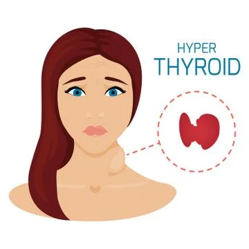 Woman with hyper thyroid Stock Illustration
