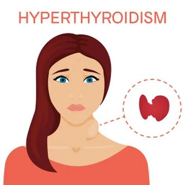 Woman with hyper thyroid Stock Illustration