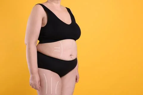 Woman with marks on body before cosmetic surgery operation on orange backgrou Stock Photos