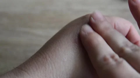 Woman with mosquito bite applying cream closeup video Stock Footage 242515075