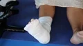 Woman with plaster on the right foot HD Footage