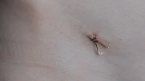 Woman put patch on the tripe, close up Stock Footage 47226416