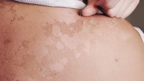 Woman with red, itchy skin after tanning Stock Footage 135863762