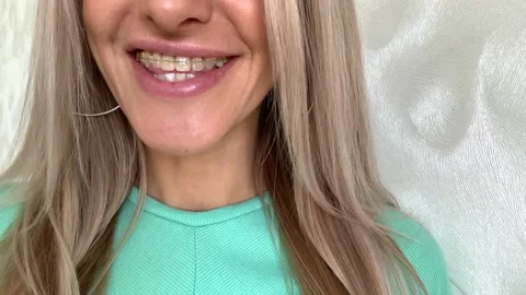 Woman with sapphire braces Stock Footage 166319877