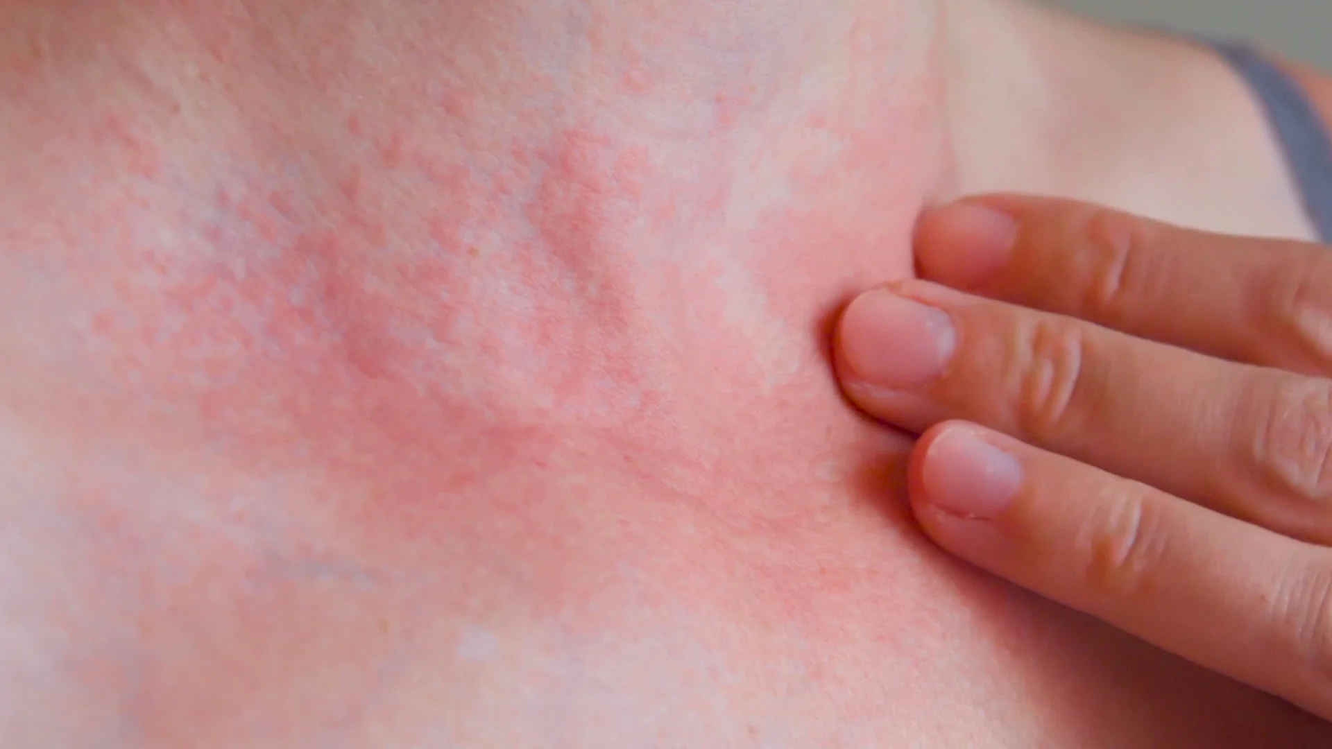 Here's Why You Get Itchy, And Why Scratching Feels So Good : ScienceAlert