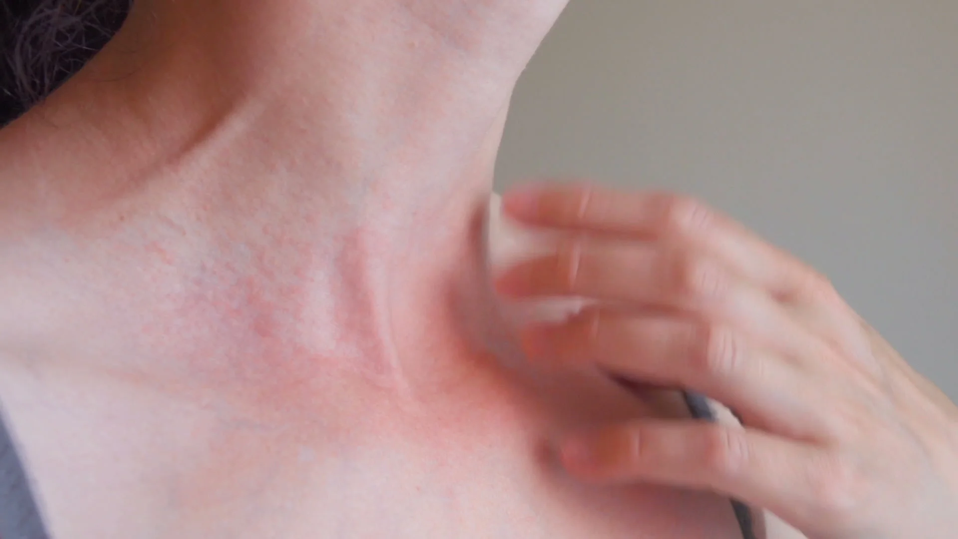Can You Get A Skin Rash From Stress? - Scripps Health