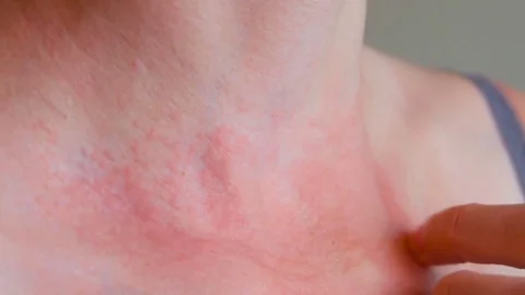 Woman scratch the itch with hand, Neck. Red spots on the neck, allergies, p.. Stock Footage 75862720