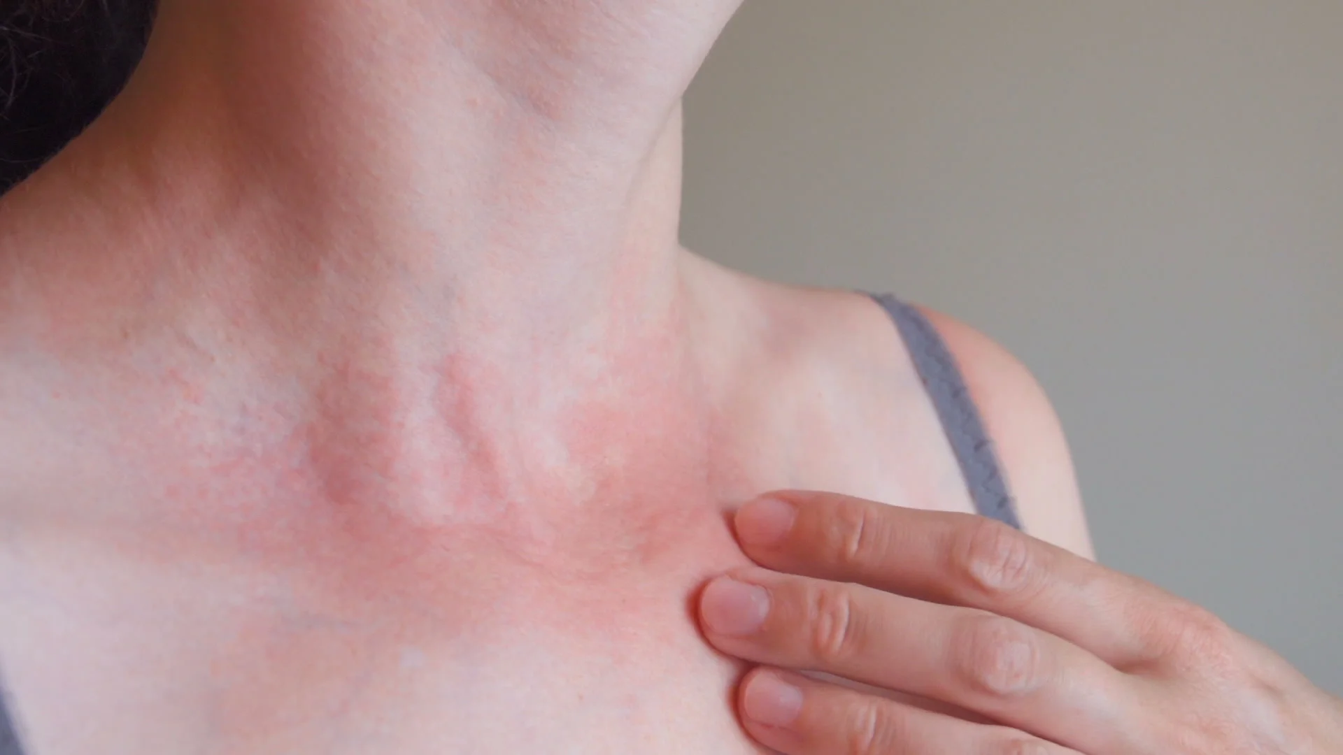 Itchy Neck: Symptoms, Causes, Treatments, and More
