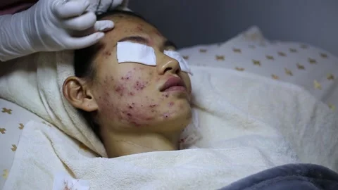 A woman with a severe acne problem on her face. Acne pressing, skin problem.. Stock-Footage 336935118
