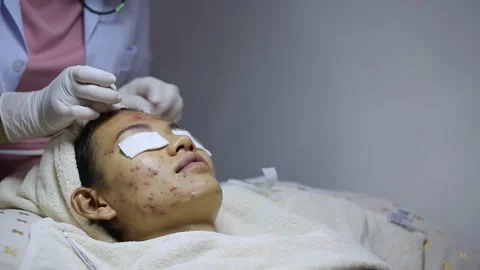 A woman with a severe acne problem on her face. Acne pressing, skin problem.. Stock Footage 336935124