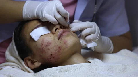 A woman with a severe acne problem on her face. Acne pressing, skin problem.. Stock Footage 336935378