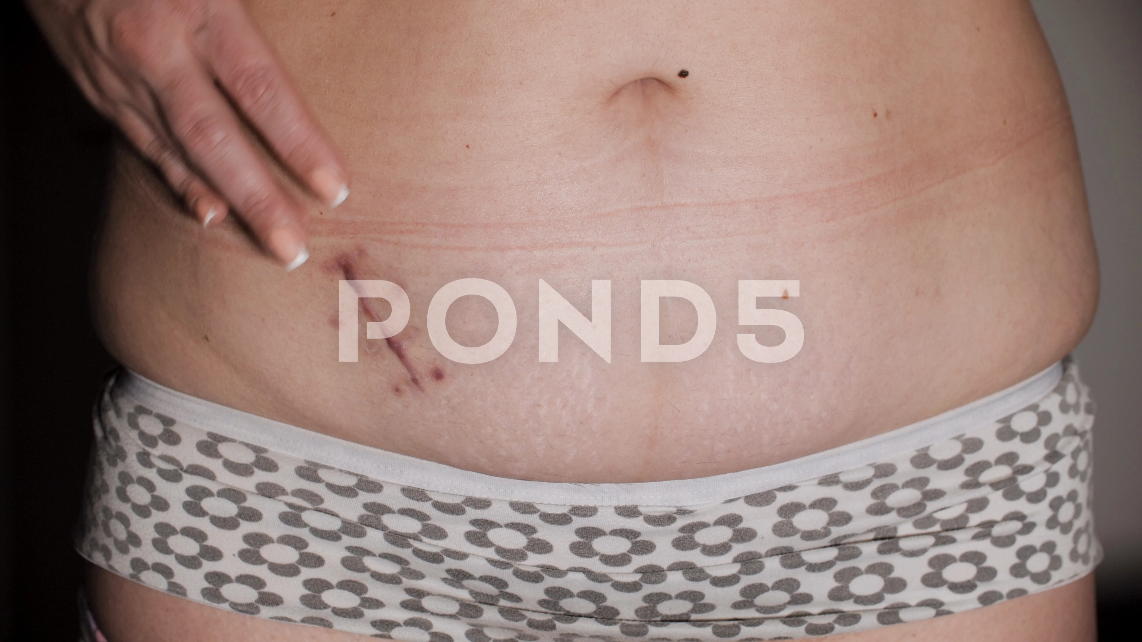 appendix scar removal before and after