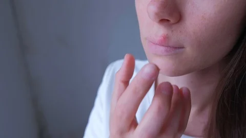 Woman smears her sore on upper lip with ointment from herpes infection, closeup. Stock Footage 123749374