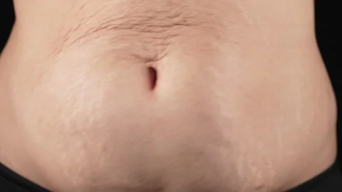 Woman with stretch marks on abdomen after pregnancy. Natural body texture Stock Footage 220093053