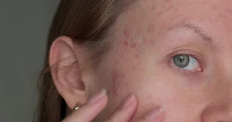Woman touching post acne scars. Stock Footage 160063388