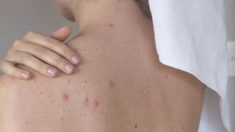 Woman touching sensitive back with acne and irritation. Sensitive skin reacts Stock Footage 331573773