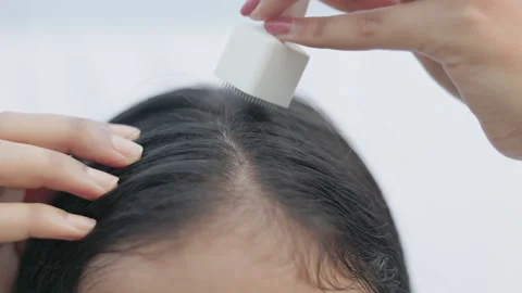 Woman using derma stamp on head for stimulating hair growth, microneedling Stock Footage 315510015