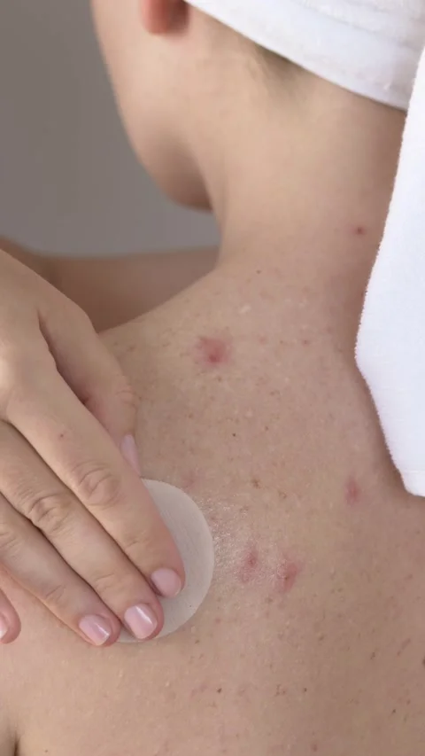 Woman using pads on back with acne and irritation. Acne treatment routine Video stock 331501177