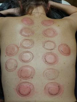 A woman's back in round red spots from treatment with non-traditional medical Stock Photos