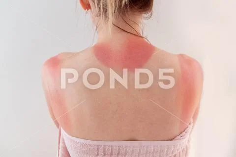 Woman's back skin hurt from sun burn. Stock Photos