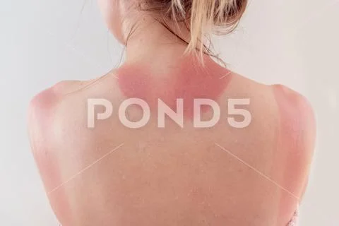 Woman's back skin hurt from sun burn. Stock Photos