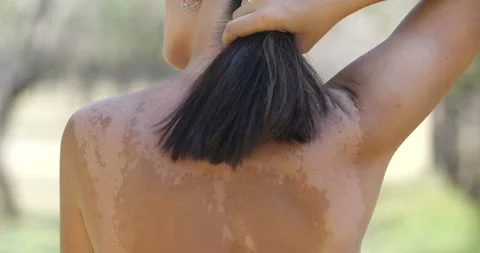 Woman's back with uneven pigmentation Stock Footage 138862344
