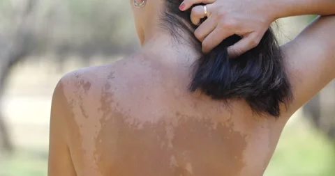 Woman's back with uneven pigmentation Stockbeeldmateriaal 138862370