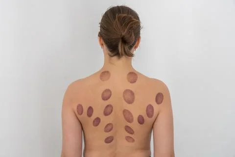 A woman's bare back with numerous large, circular, deep purple bruises afte.. Fotos de archivo