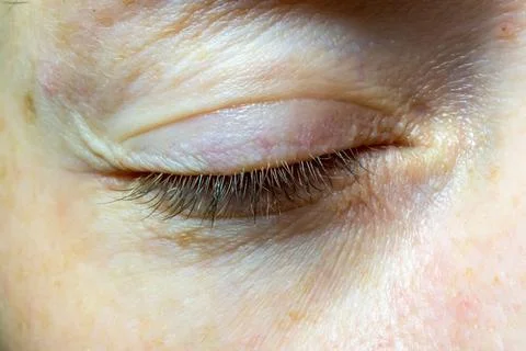 Woman's closed eye close-up. Problematic skin near the eye Stock Photos