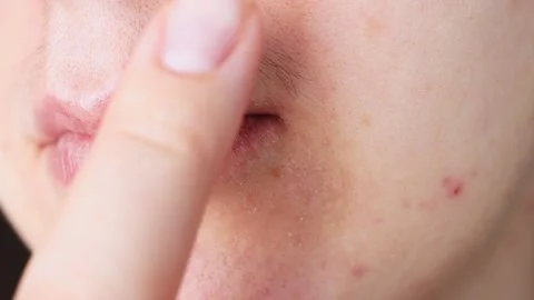 Woman's face with problematic skin and hair near the mouth. Disease, hirutism. Stock Footage 170476169