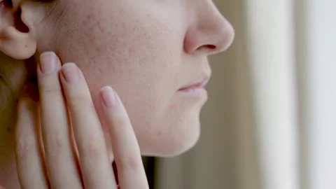Woman's face in profile with problem skin pigment spots scars  Video stock 278347379
