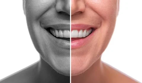 A woman's face is split in half for good and bad skin. Isolated on white Stock Photos