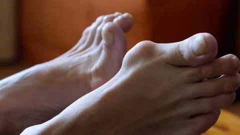 Woman's foot with bunion Stock Footage 109276956
