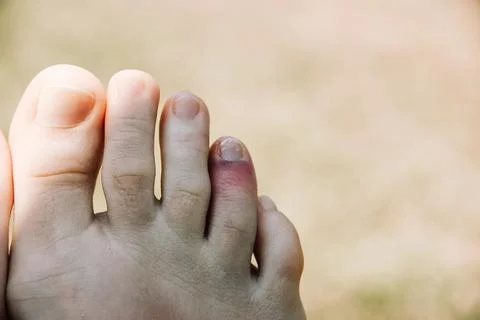 A woman's foot with an injured fourth toe. Red toe after bruise, blow, fracture Stock Photos