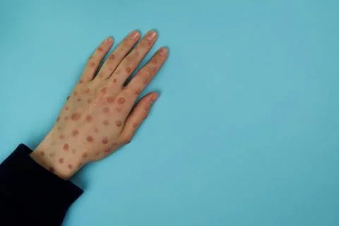Woman's hand affected by monkeypox or other virus Stock Photos