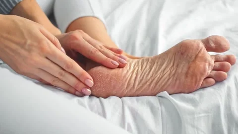 Womans hands touching the dry rough cracked skin of her bare foot. Stock Footage 178418140